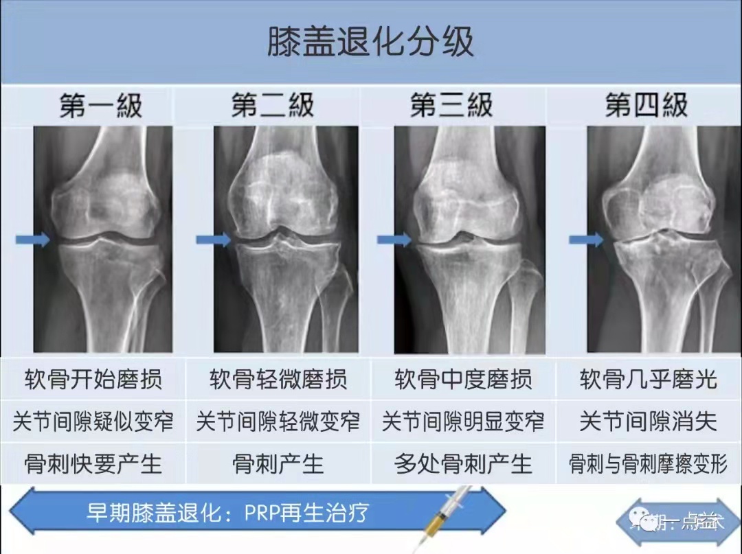 【knee膝最常见疼痛—髌骨软化】-健康160
