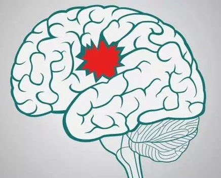 贵阳脑卒中治疗，贵阳脑卒中医院，贵州脑卒中治疗