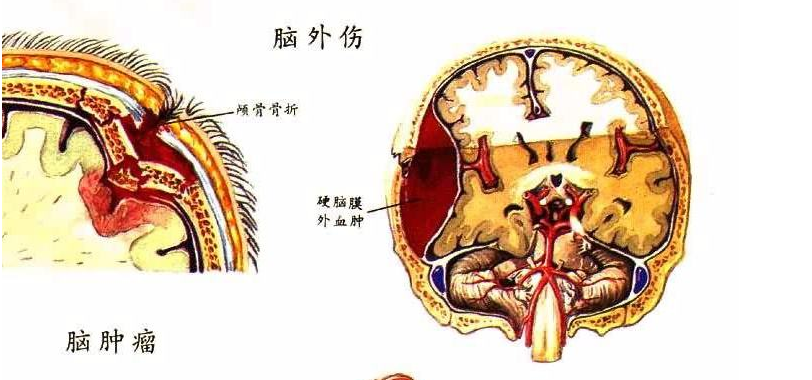 贵阳脑外伤康复,贵州脑外伤,贵州康复医院