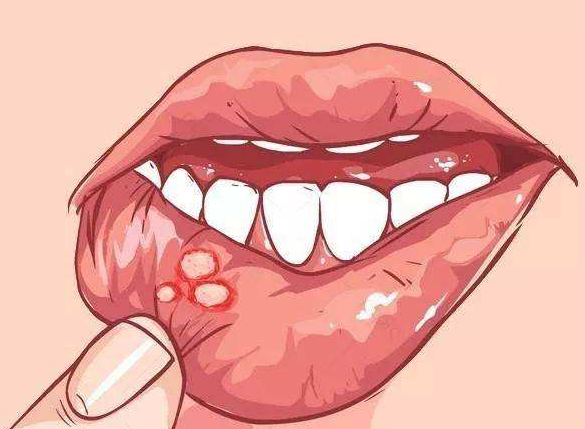 贵州口腔溃疡,贵阳口腔溃疡治疗