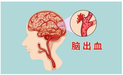 得了腦出血後治療辦法是什麼-貴州省人民醫院郵電醫院