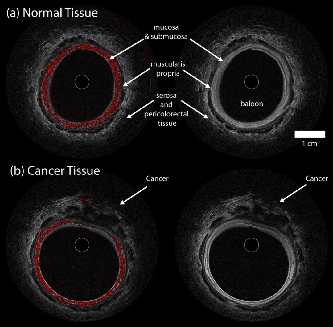 新突破！用于直肠癌成像的便携式光声显微镜和超声系统