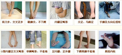 脑性瘫痪的言语特征及其康复对策-上海慧敏医疗器械有限公司