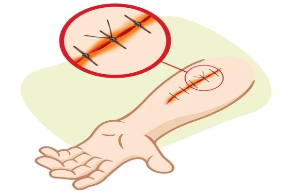 可吸收缝线抗张力强度大小需要什么专业测试仪检验？