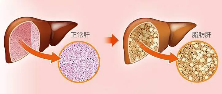 脂肪肝患者的福音:药物治疗的新选择