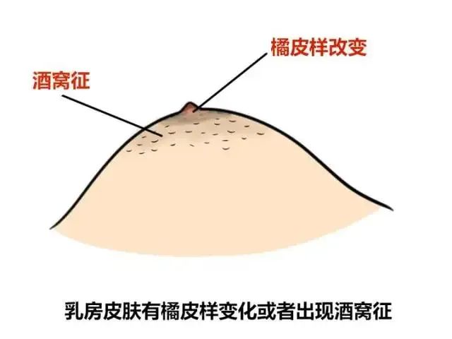 医者说|预防乳腺癌从乳腺结节开始-暨南大学附属顺德医院（佛山市顺德区第二人民医院）