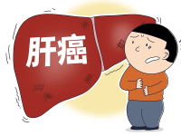 肝癌