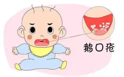 【健康科普】新生儿科：新生儿鹅口疮的护理-朔州市朔城区人民医院