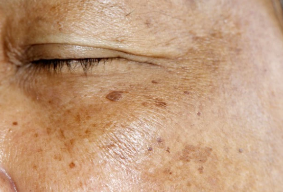 生活中如何预防老年斑？涂抹生姜牙膏可能会刺激病变！